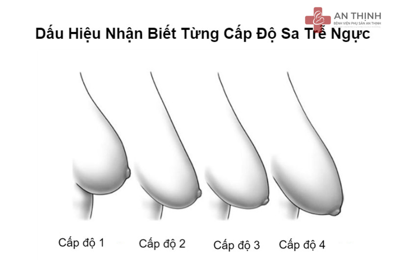Mức độ sa trễ được chia thành 4 cấp độ từ nhẹ đến nặng để xác định phương pháp nâng phù hợp