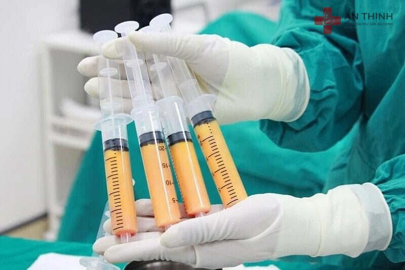 Treo sa trễ kết hợp cấy mỡ tự thân giúp nâng ngực và tăng độ đầy đặn tự nhiên không cần túi độn